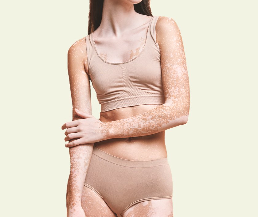 Diet For Vitiligo