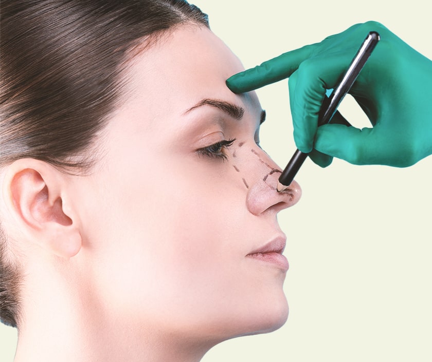 Nasal Dorsum Correction