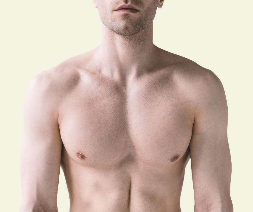 Type 5 Gynecomastia – Significant Breast Roll