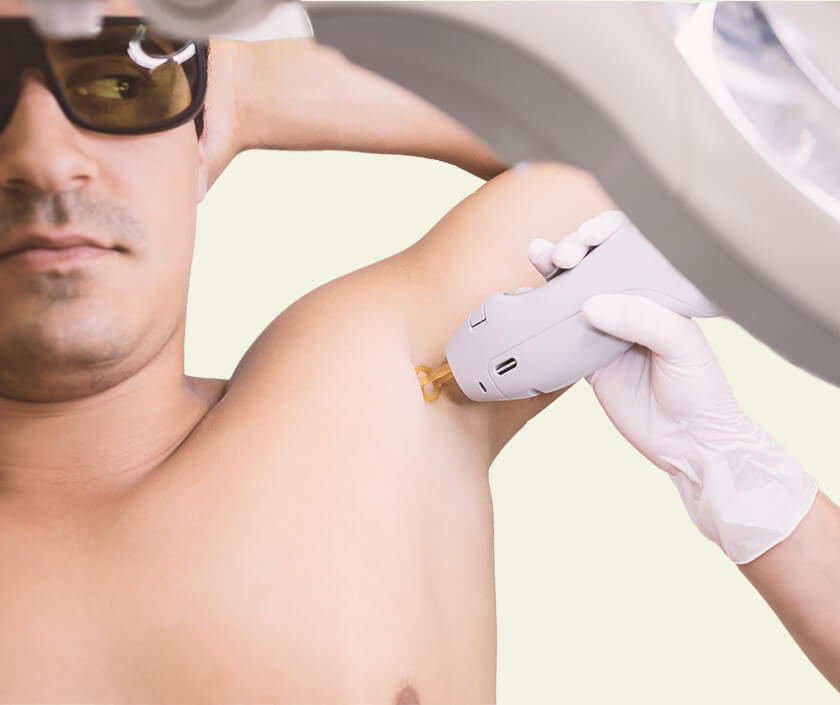 Laser Hair Removal for Male
