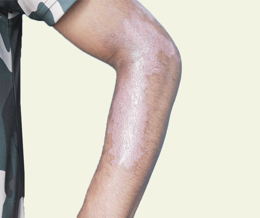 Punch Grafting For Vitiligo