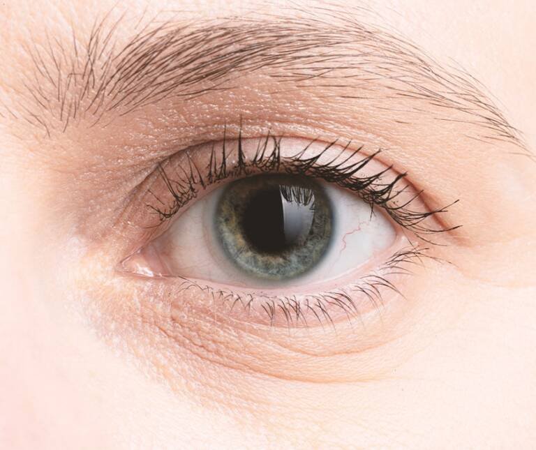 Lower Eyelid Wrinkles Treatment in Surat | Elegance Clinic