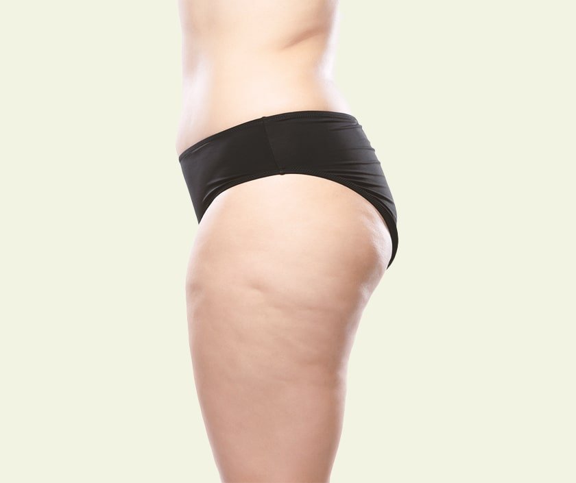 Inner Thighs Liposuction