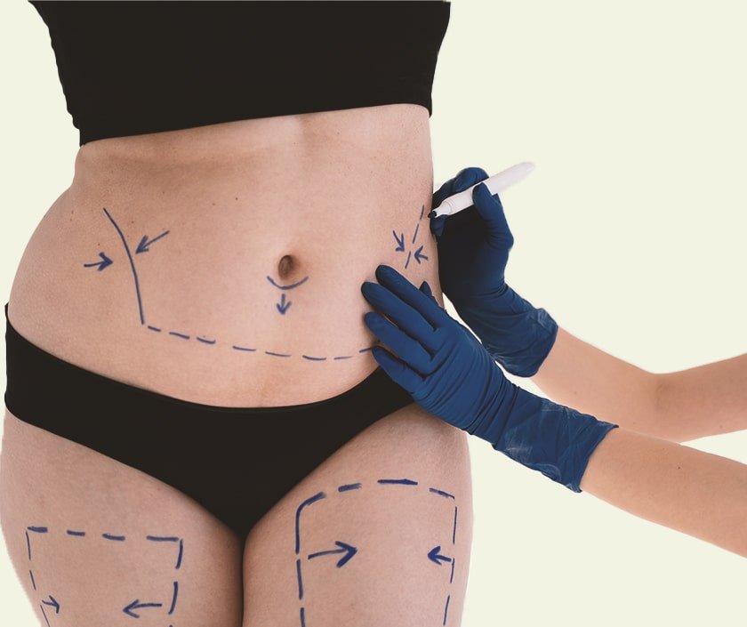 Reverse Tummy Tuck