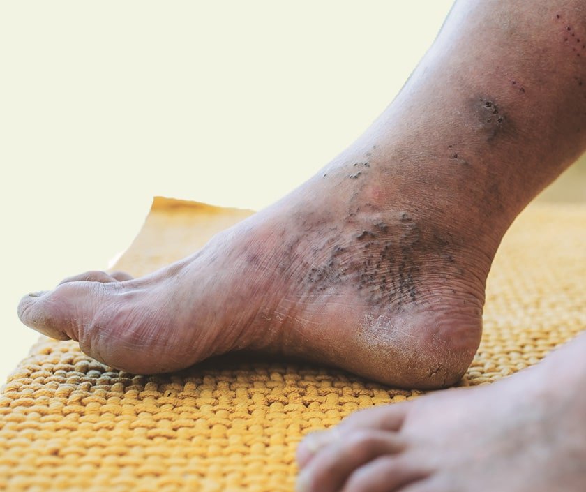 Varicose Veins Ulcer