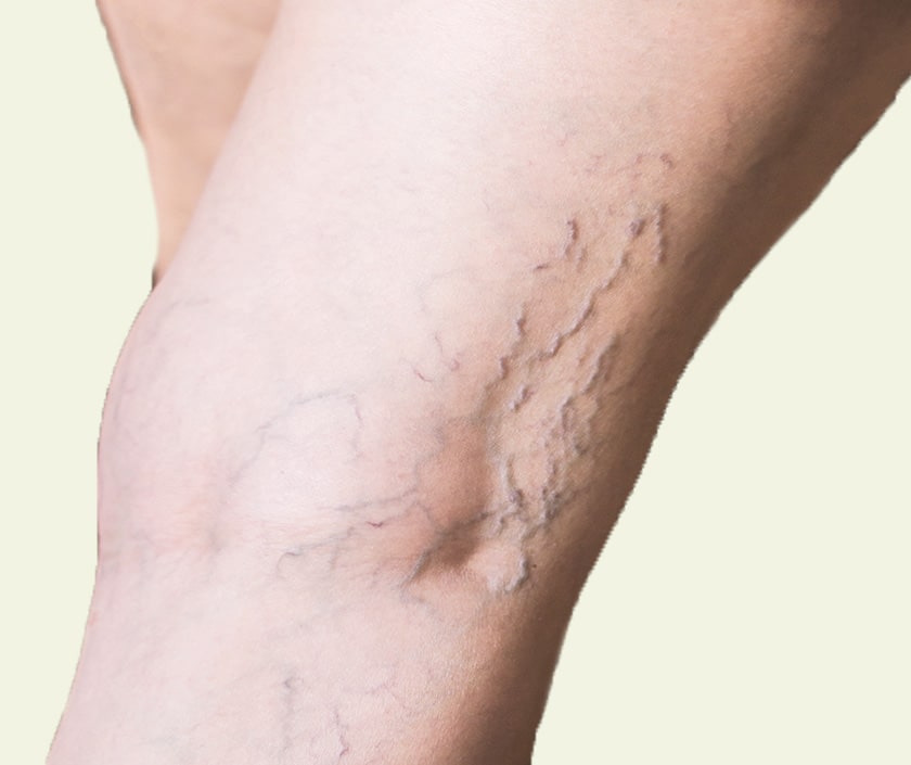 Sclerotherapy For Incompetent Perforators