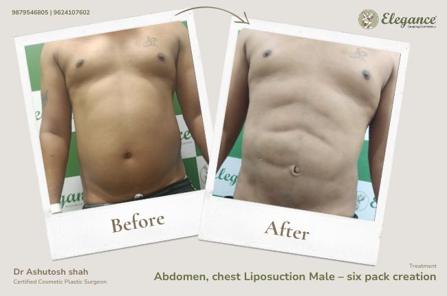 Abdomen, chest Liposuction Male – six pack creation