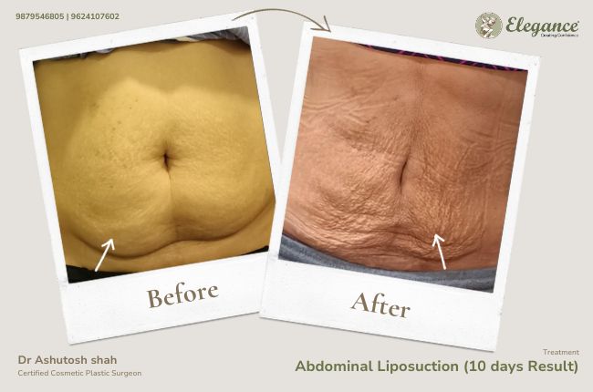 Abdominal Liposuction (10 days Result)