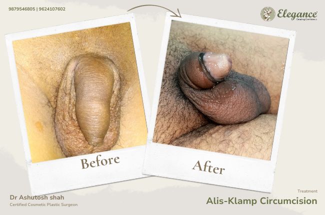 Alis-Klamp Circumcision 2