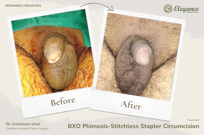 BXO Phimosis-Stitchless Stapler Circumcision