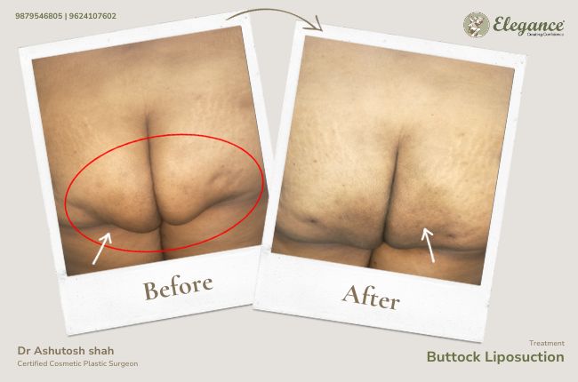Buttock Liposuction