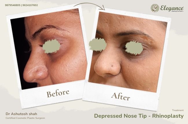 Depressed Nose Tip - Rhinoplasty