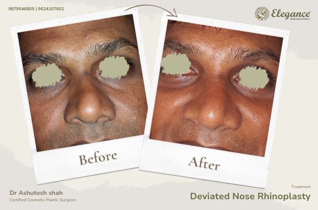 Deviated Nose Rhinoplasty (2)