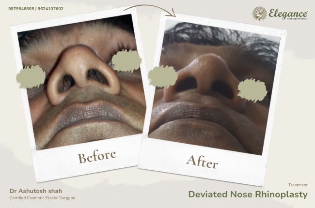 Deviated Nose Rhinoplasty (3)