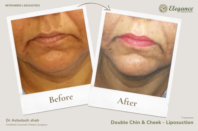 Double Chin _ Cheek - Liposuction