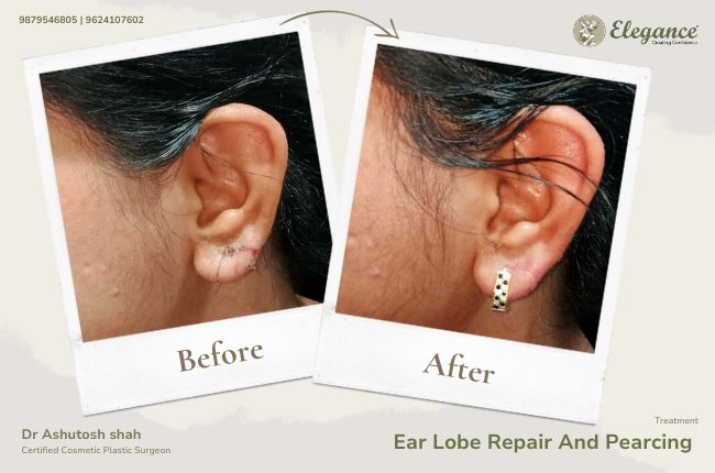 Ear Lobe Repair And Pearcing 2