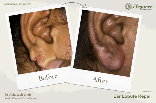 Ear Lobule Repair