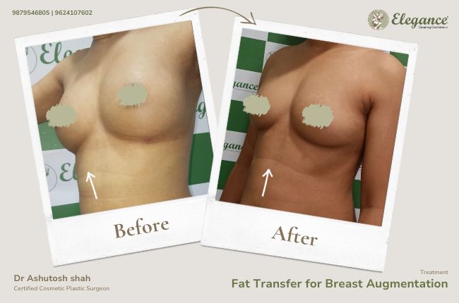 Fat Transfer for Breast Augmentation (1)