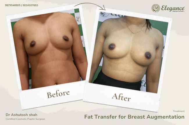 Fat Transfer for Breast Augmentation