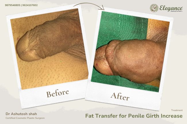 Fat Transfer for Penile Girth Increase (2)