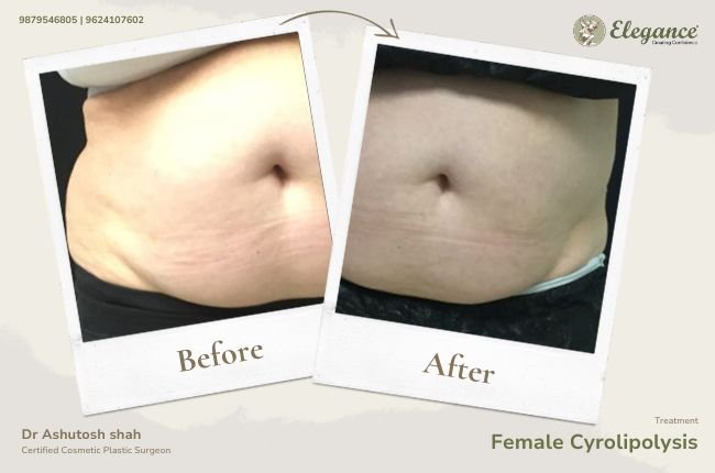 Female Cyrolipolysis