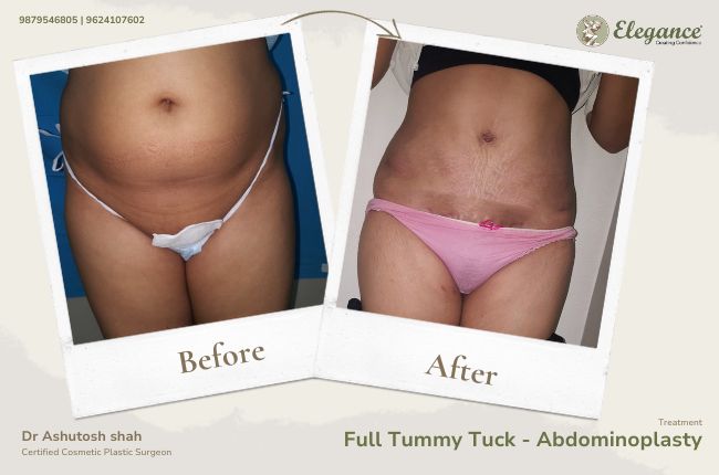 Full Tummy Tuck - Abdominoplasty (2)