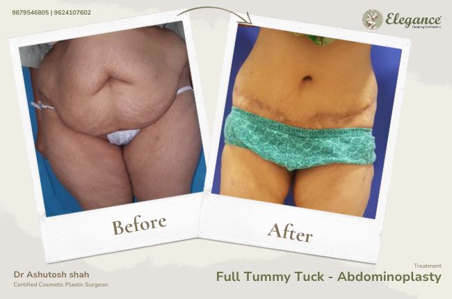 Full Tummy Tuck - Abdominoplasty