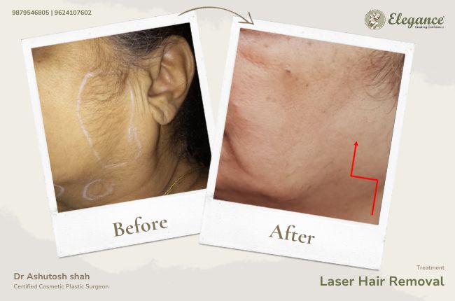 Laser Hair Removal (2)