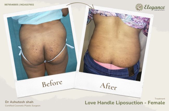 Love Handle Liposuction - Female