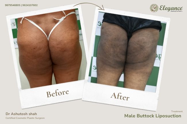 Male Buttock Liposuction