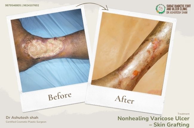 Nonhealing Varicose Ulcer – Skin Grafting (2)