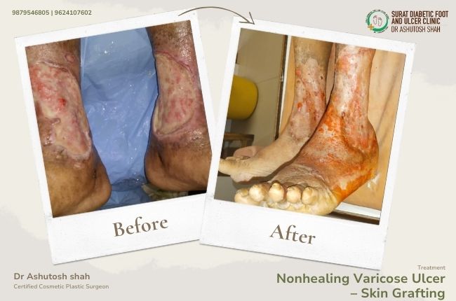 Nonhealing Varicose Ulcer – Skin Grafting