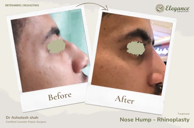 Nose Hump - Rhinoplasty (2)