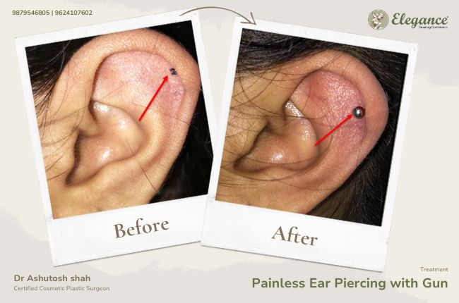 Painless Ear Piercing with Gun_14