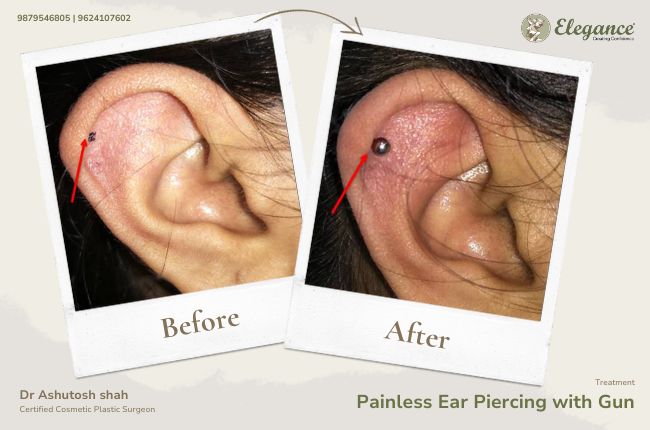 Painless Ear Piercing with Gun_15