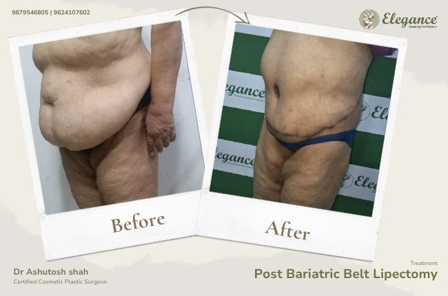 Post Bariatric Belt Lipectomy (2)