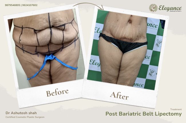 Post Bariatric Belt Lipectomy