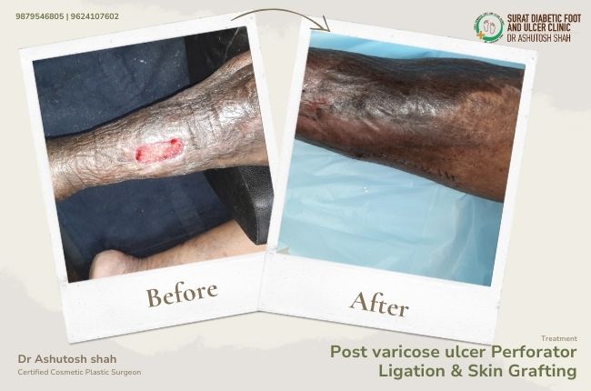 Post varicose ulcer Perforator Ligation _ Skin Grafting