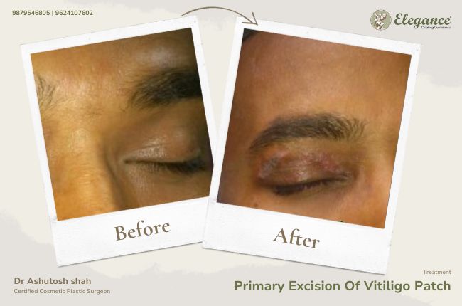 Primary Excision Of Vitiligo Patch