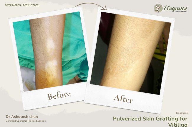 Pulverized Skin Grafting for Vitiligo (2)
