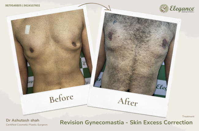 Revision Gynecomastia - Skin Excess Correction _38