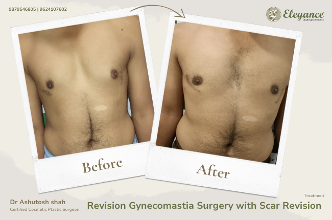 Revision Gynecomastia Surgery with Scar Revision _39