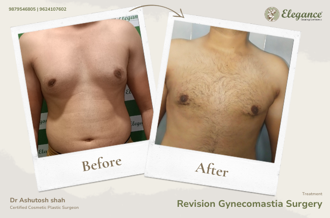 Revision Gynecomastia Surgery_33