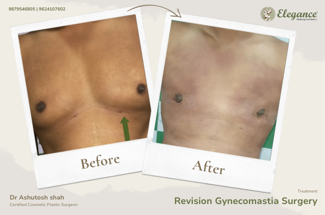 Revision Gynecomastia Surgery_35