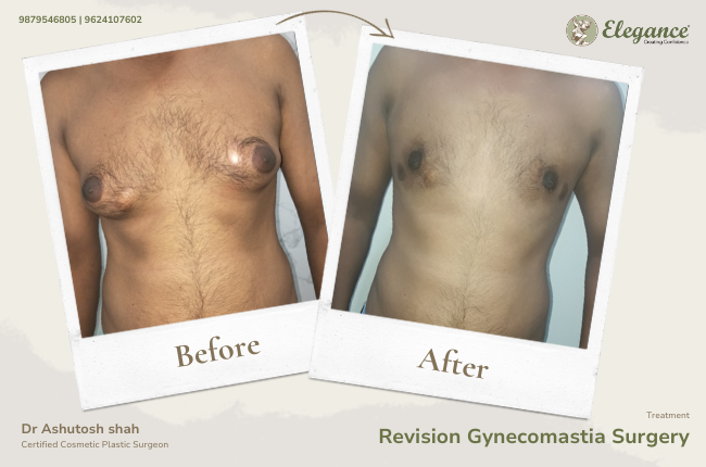 Revision Gynecomastia Surgery_40