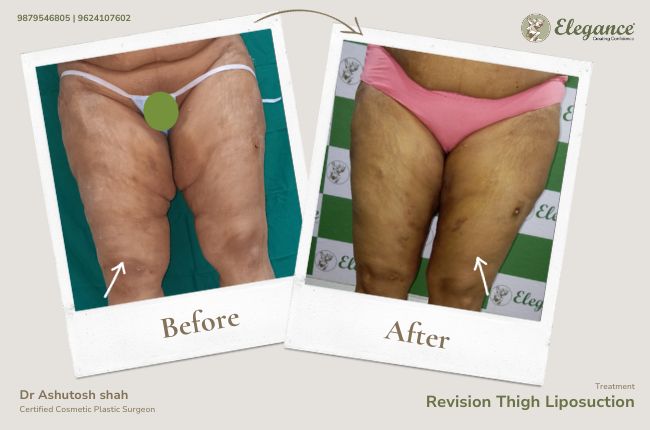 Revision Thigh Liposuction
