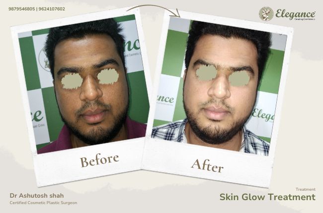 Skin Glow Treatment (2)