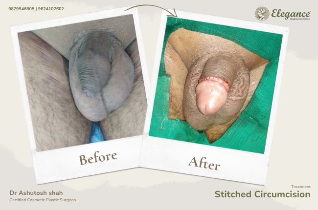Stitched Circumcision (6)