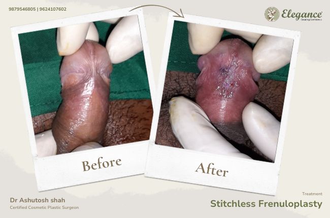 Stitchless Frenuloplasty (2)