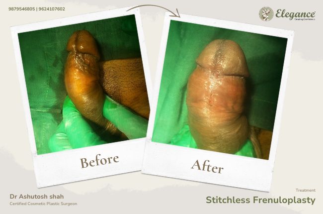Stitchless Frenuloplasty (6)